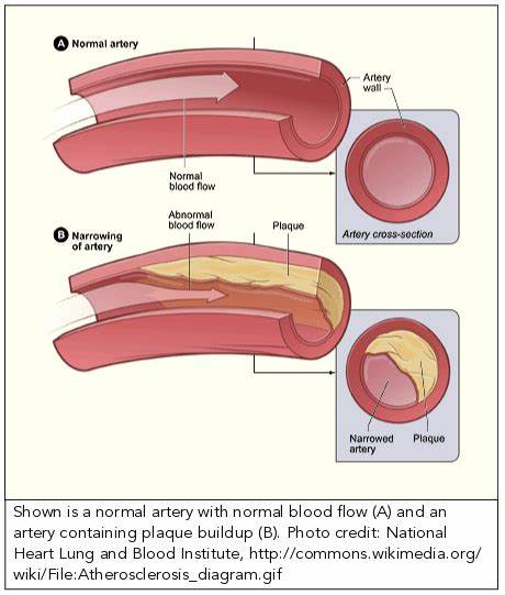 A New Cause of Atherosclerosis
