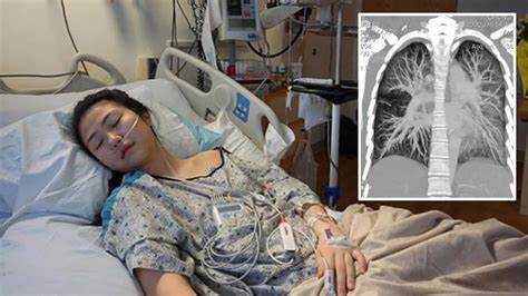 Long Covid destroys teenage lungs in ways doctors never saw