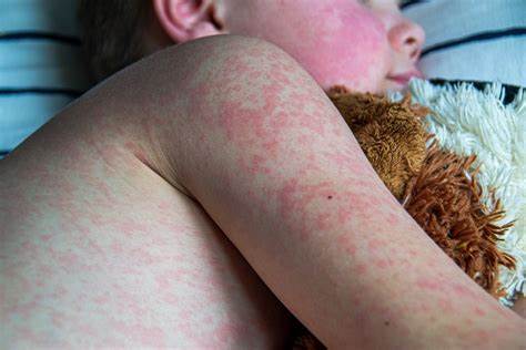 Child's Death Shows How Measles in the Brain Can Kill Years After an Infection