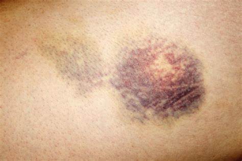 Six reasons why hematomas suddenly appear and what they indicate about our health