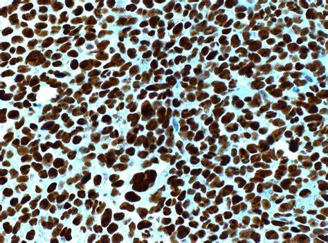 Pathology Outlines - NPM1