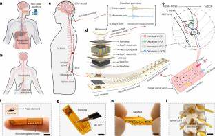 A Game-Changing Wireless Implant for Personalized Chronic Pain Relief