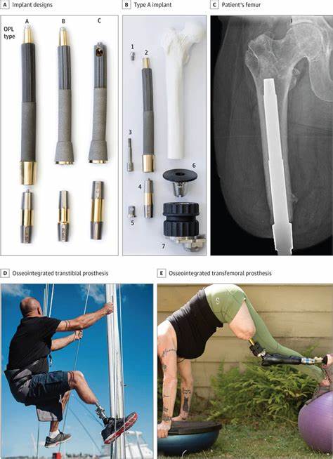 The expert became the patient? (prosthetic osseointegration)