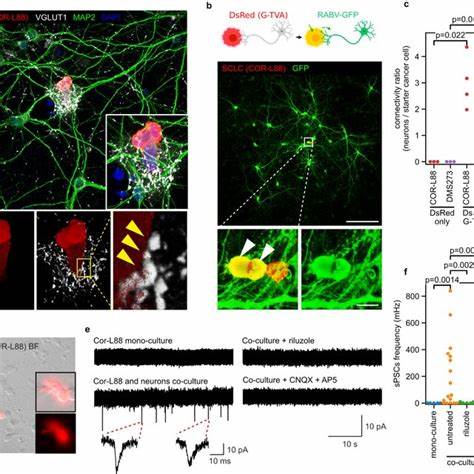 Functional synapses between neurons and small cell lung cancer