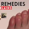 Chilblains | Diabetes UK Forum