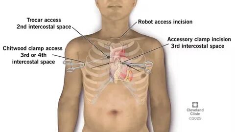 Robotic neck incision replaces heart valve with no chest opening in world first
