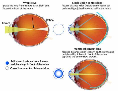 Contact lenses used to slow nearsightedness in youth have a lasting effect
