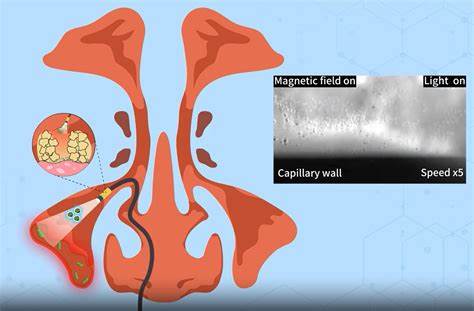 Light-sensitive magnetic robots can clear up bacterial infections in sinuses