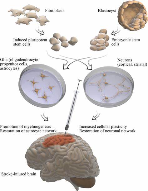 Stem cell transplant for stroke leads to brain cell growth in mice