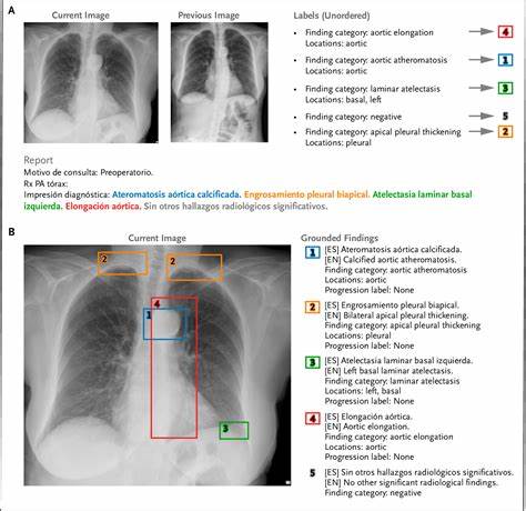 PadChest-GR: A bilingual grounded radiology reporting benchmark for chest X-rays
