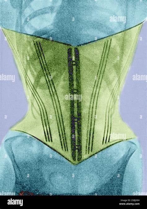 The Corset X-Rays of Dr Ludovic O'Followell (1908)