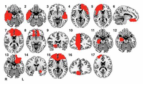 Study Finds Link Between Brain Injury and Criminal Behavior