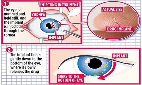 From Tiny Implants to Hydrogen Therapy, New Advances Target Vision Loss - Securities.io