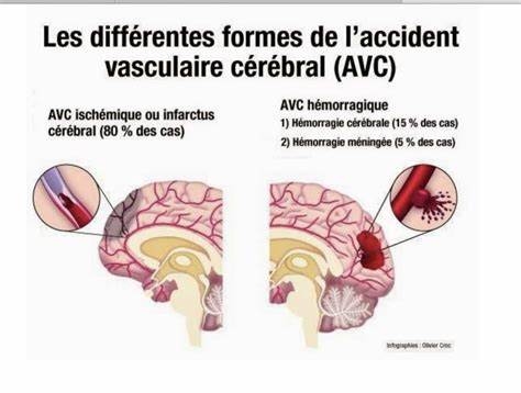 Selon la science, cette pratique sexuelle pourrait causer des AVC chez 