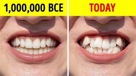 Humans used to have straighter teeth – what changed?