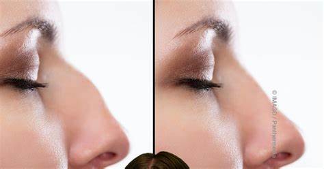 BGH verbietet Vorher-nachher-Werbefotos zu Beauty-Eingriffen