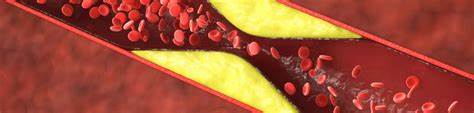 Coronary atherosclerosis is a silent killer, but we have tools to stop it