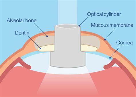 Osteo-Odonto-Keratoprosthesis