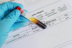 Туморни маркери: какво са, кога се изследват - Лекар.БГ