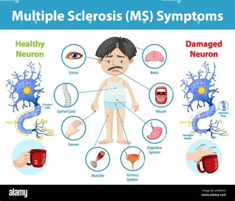 Multiple Sklerose (MS)