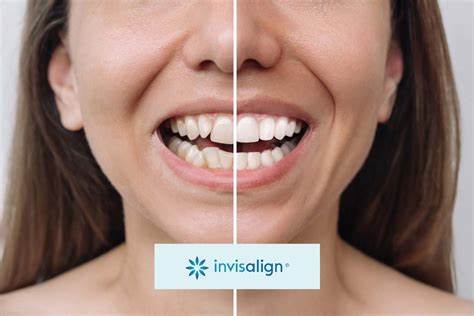 Invisalign Parent’s Stock Is Falling. There’s Less Demand for Straight Teeth