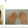 The first documented case of neotenic complex syndrome