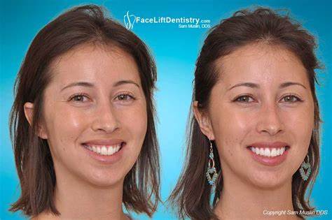 It's not that your teeth are too big: your jaw is too small (2017)