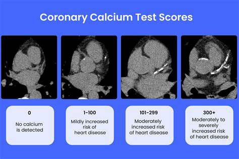 CAC Test Can See a Heart Attack in Your Future