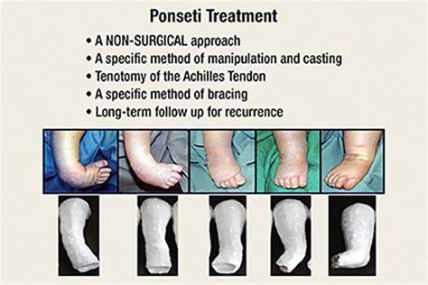 The Ponseti Method to Cure Clubfoot
