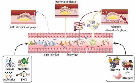 Molecule produced by gut bacteria causes atherosclerosis