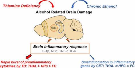 Thiamine Deficiency and Neuroinflammation Contribute to Alcohol Use Disorder