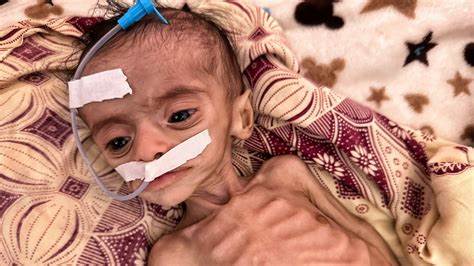 The photograph of a starving Gaza baby